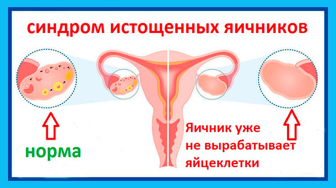 нормальный яичник слева и яичник при синдроме истощения яичников справа