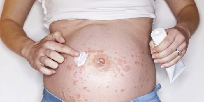 кожная сыпь у беременных