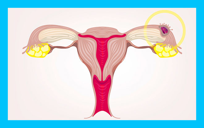 рисунок внематочной беременности в маточной трубе