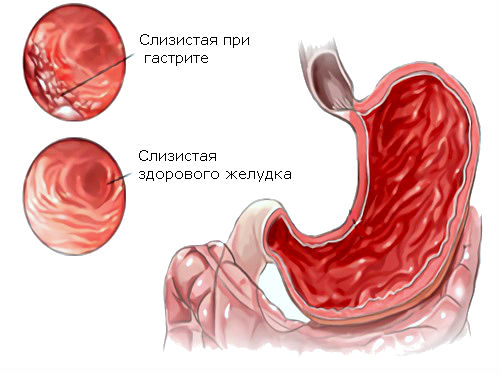 Схема гастрита желудка