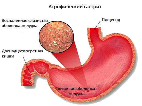 Как лечить атрофический гастрит желудка