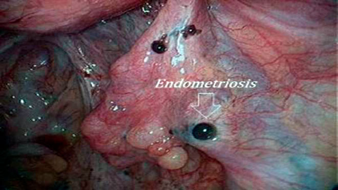 фотография эндометриоза