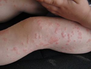 Аллергия на йод