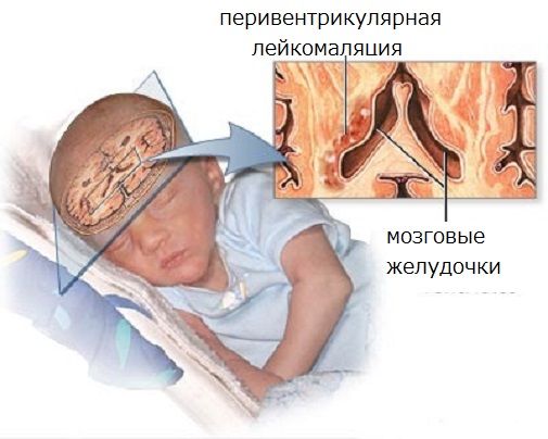 Патология мозга новорожденного