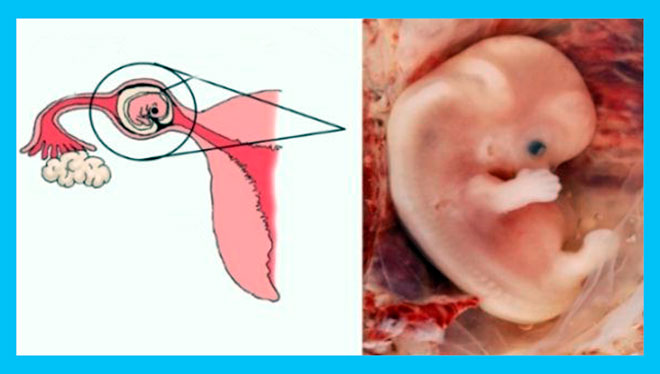 пример внематочной имплантации в фаллопиевой трубе