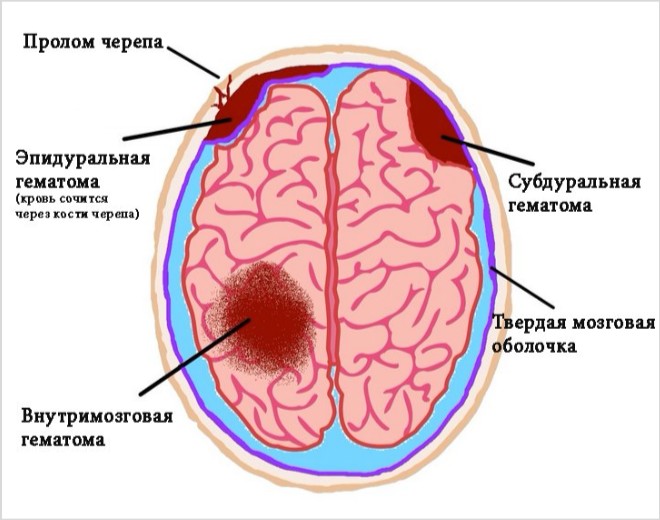 Образование гематом в головном мозге и их лечение