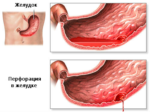 Схема перфорации желудка