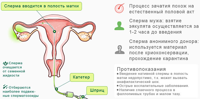 инфографика проведения инсеминации в полость матки
