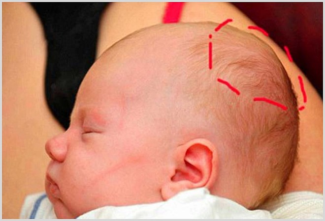 Последствия гематомы на голове после ушиба у ребенка и взрослого