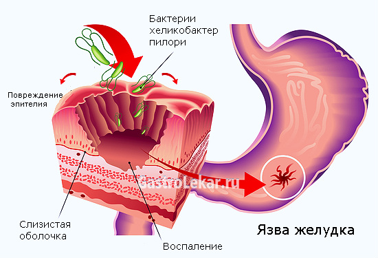 Схема возникновения желудочной язвы при эрозивно-язвенном гастрите