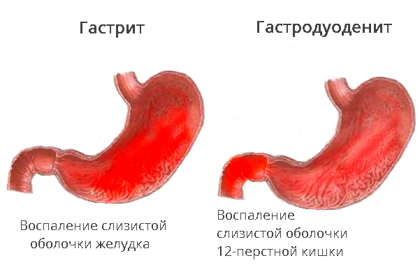 Схема расположения гастрита и гастродуоденита
