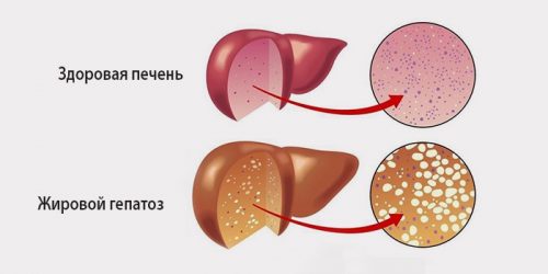 Жировой гепатоз или дистрофия печени