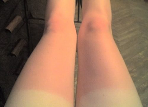 Солнечные ожоги на ногах