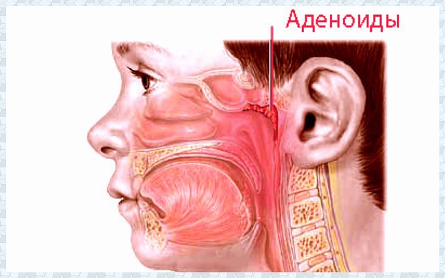 Аденоиды в горле у взрослых фото