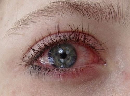 Покраснение глаз после процедуры наращивания ресниц