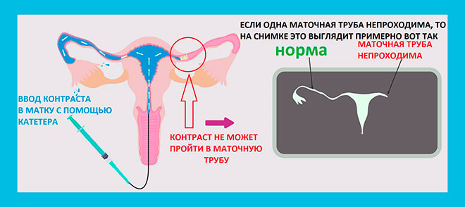 рисунок объясняющий принцип проведения исследований прохождения маточных труб с применением контрастного вещества