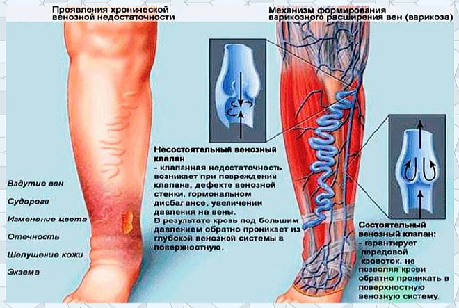 Лечение варикозного расширения ног