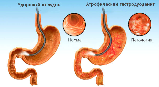 Вид атрофического гастродуоденита через эндоскоп