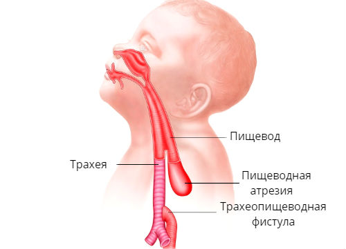 Схема атрезии пищевода у новорожденного