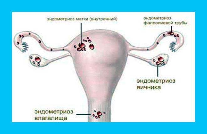 примеры генитального эндометриоза