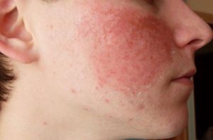 Аллергия на коже лица
