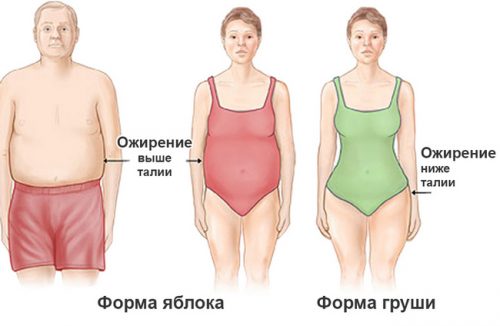 Типы ожирения по форме