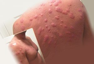 Аллергия на ткань