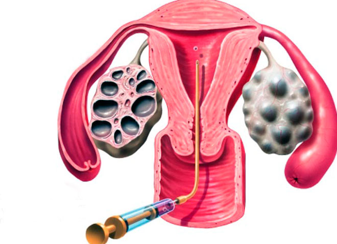 ознакомительная кртинка подсадки эмбриона после криоконсервации