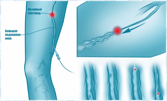 Лазерное лечение варикозной болезни ног