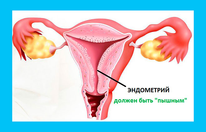 нарисованная матка женщины с указанием местоположения эндометрия