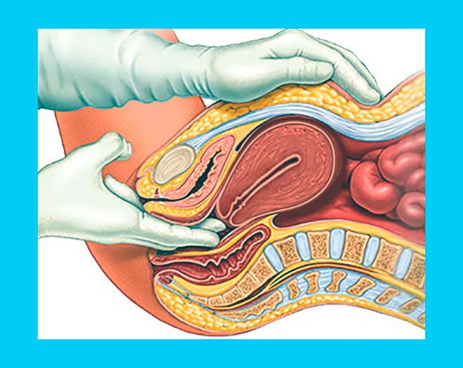 рисунок метода диагностики поликистоза яичников при гинекологическом осмотре
