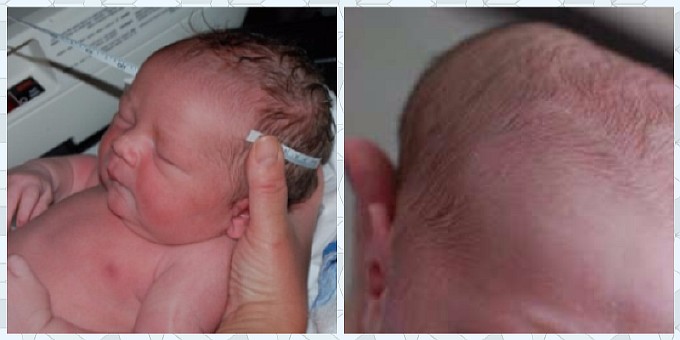Чем опасна гематома (шишка) на голове новорожденного