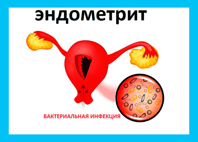 бактериальная инфекция проникает в матку при эндометрите