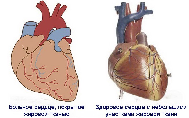 Жировая дегенерация сердца