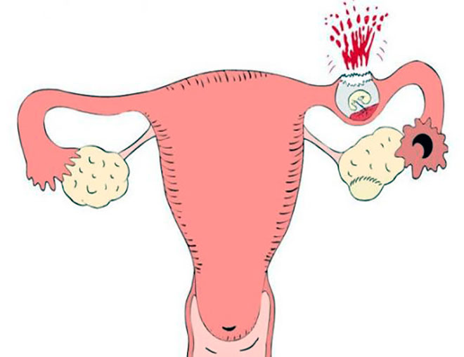 внематочная беременность с разрывом маточной трубы