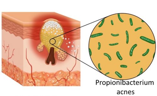 Propionibacterium acnes