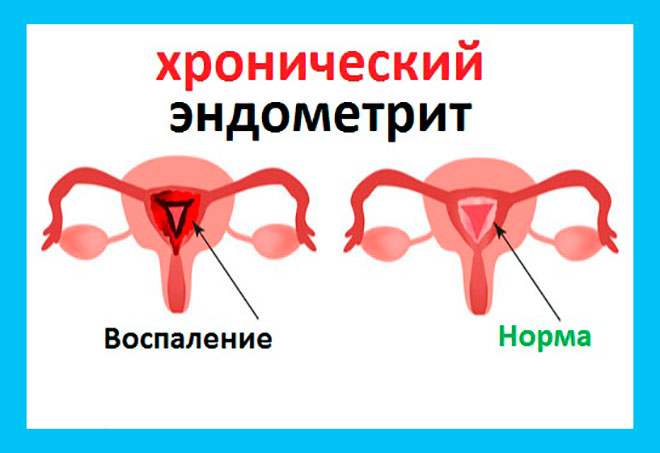 сравнение здоровой матки и матки с эндометритом