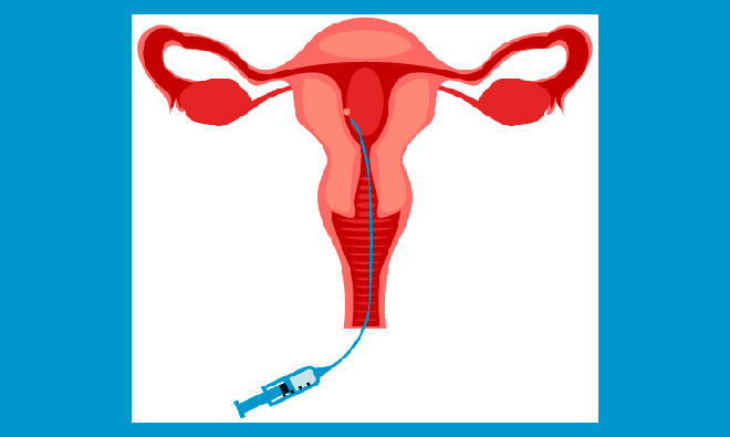 схематичный рисунок подсадки эмбриона после стимуляции перед эко