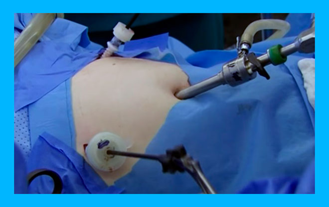 женщине в операционной делают лапароскопию маточных труб