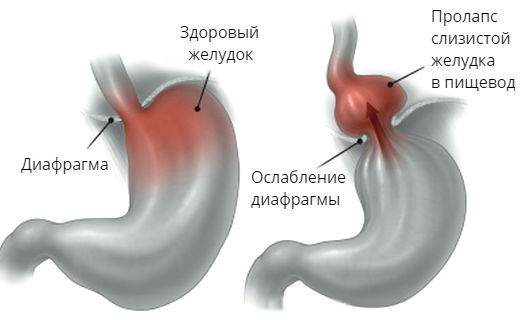 Схема пролапса слизистой желудка в пищевод