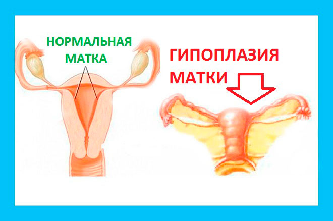 картинка со сравнением нормальной матки и детской матки