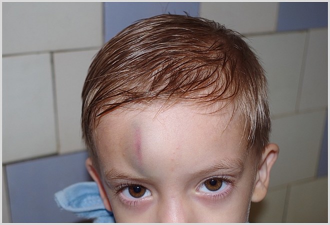 Последствия гематомы на голове после ушиба у ребенка и взрослого
